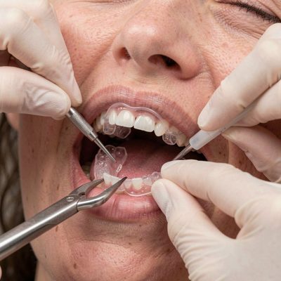 teeth whitening trays being fitted