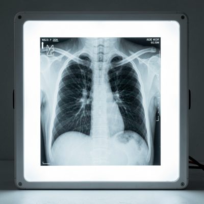 an x ray on a light box